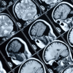 tomografía cerebral