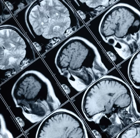 tomografía cerebral