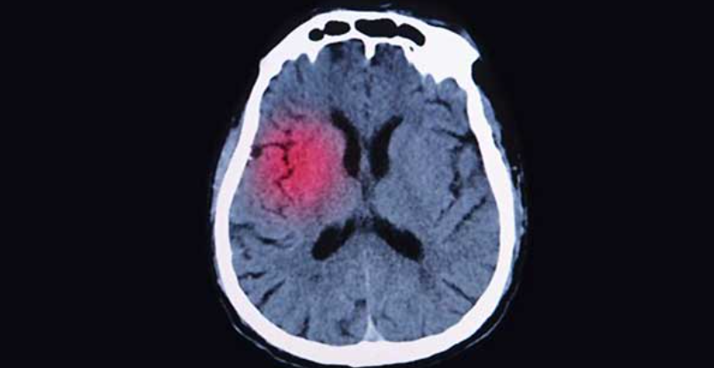 tomografia de cerebro