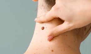 cuello de mujer con marcas en la piel