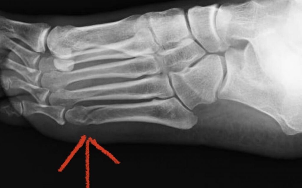 radiografía de pie con fisura