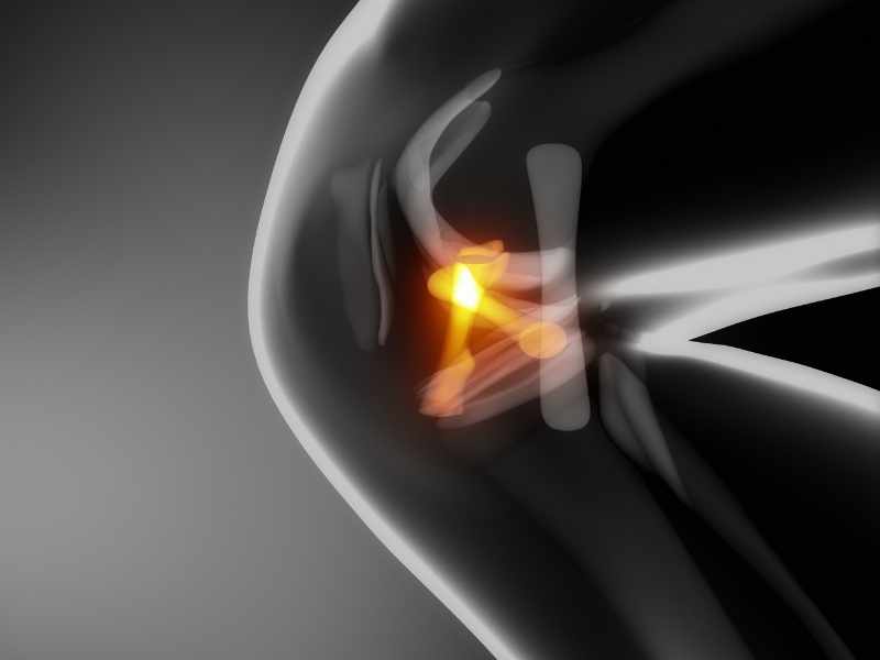 Ilustración médica de la rodilla con meniscos y ligamentos señalados.